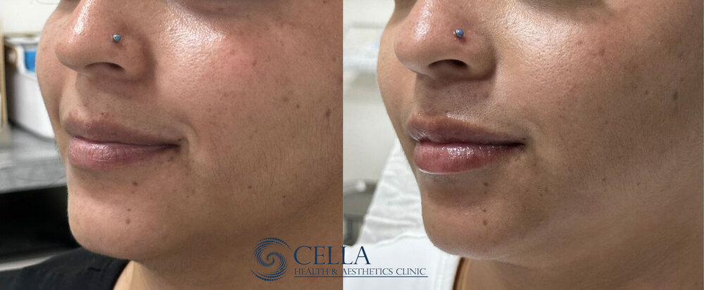 HA-Filler for lip volume 02