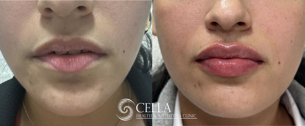 HA-Filler for lip volume 01