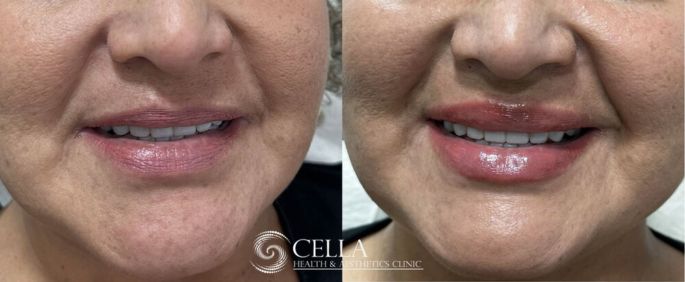 HA-Filler for lip volume 02